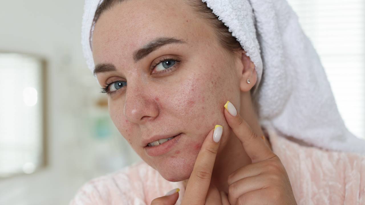Como a nutrição ajuda a reduzir a acne.